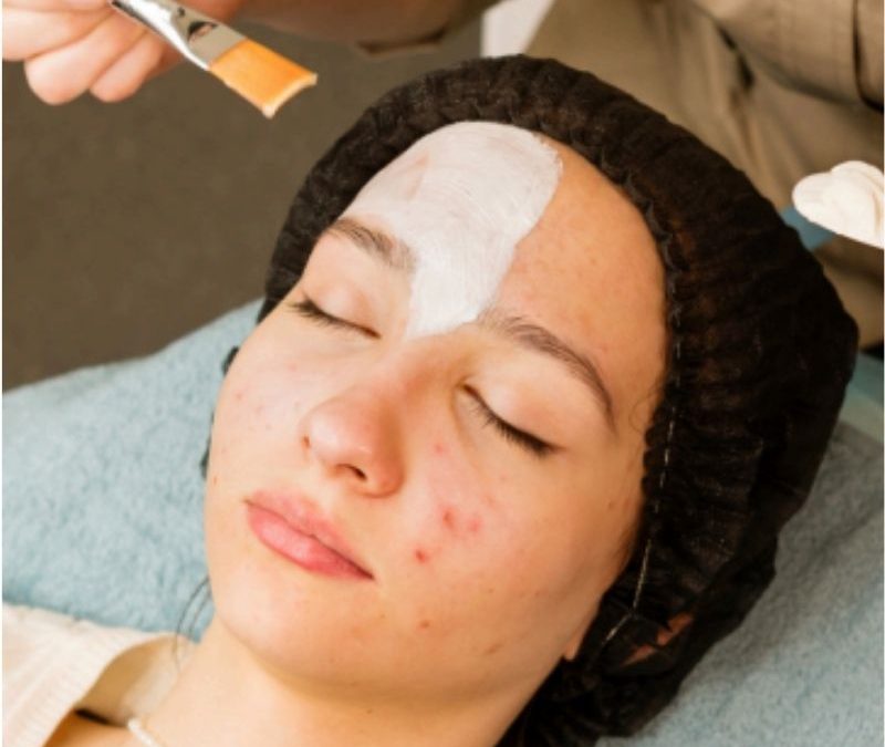Facial Acné