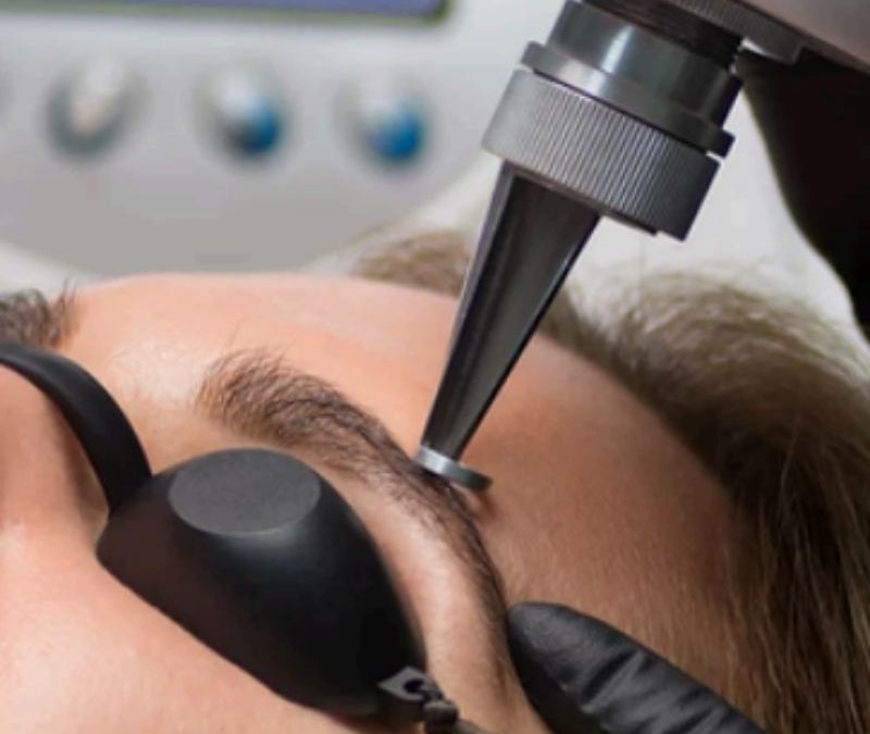 Remoción de Cejas con Láser